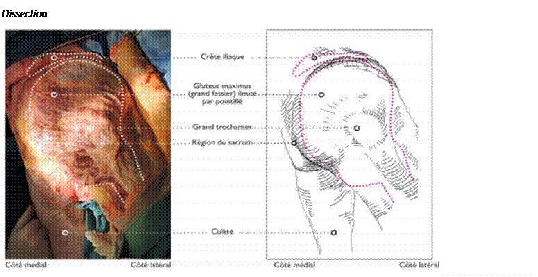 Zone de Texte: Dissection 
 
1: Muscles de la fesse
